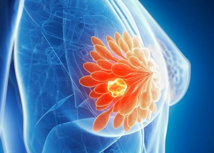 L’Hospital Universitari de Mataró transforma l’atenció a les pacients amb càncer de mama amb tractaments més personalitzats i cirurgia menys invasiva